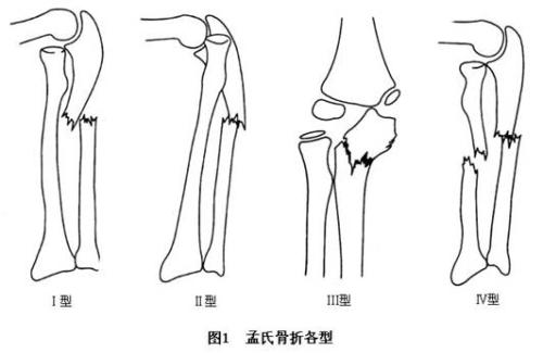 骨折肌肉萎缩恢复训练方法有哪些